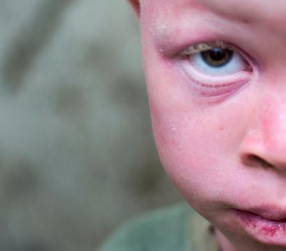 Une personne albinos